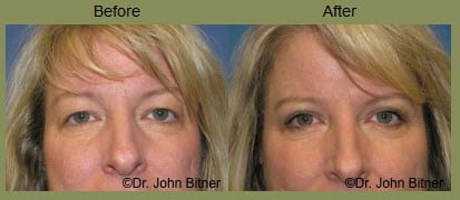 Blepharoplasty Before and After Eyelid surgery at Bitner Facial Plastic Surgery in Salt Lake City UT