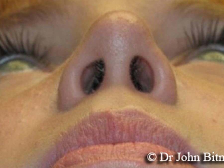 Nose (Rhinoplasty) Layton Utah