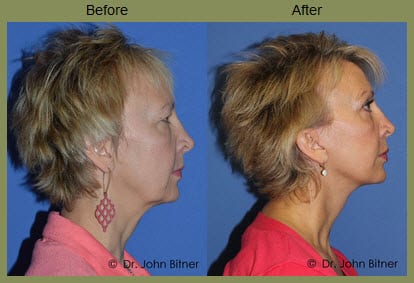 Mini Facelift  before and after photos Bitner Facial Plastic Surgery 