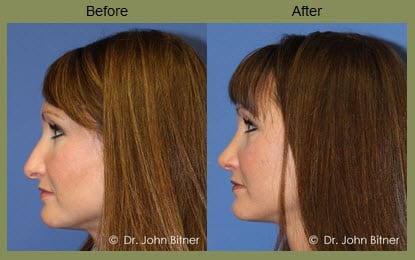 Rhinoplasty Layton, UT | Salt Lake City 