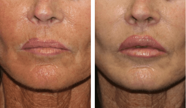 A before and after image of a woman that underwent a lip augmentation bitner facial plastic surgery