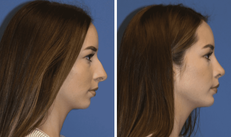 A before and after image set of a woman that underwent a chin implant and rhinoplasty procedure at Bitner Facial Plastic Surgery center. 