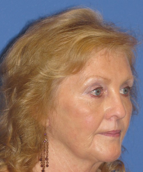 Facelift 1076 – Click HERE for more views after photo. Individual results may vary.
