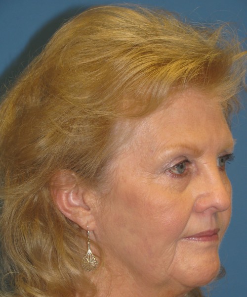 Facelift 1076 – Click HERE for more views before photo. Individual results may vary.