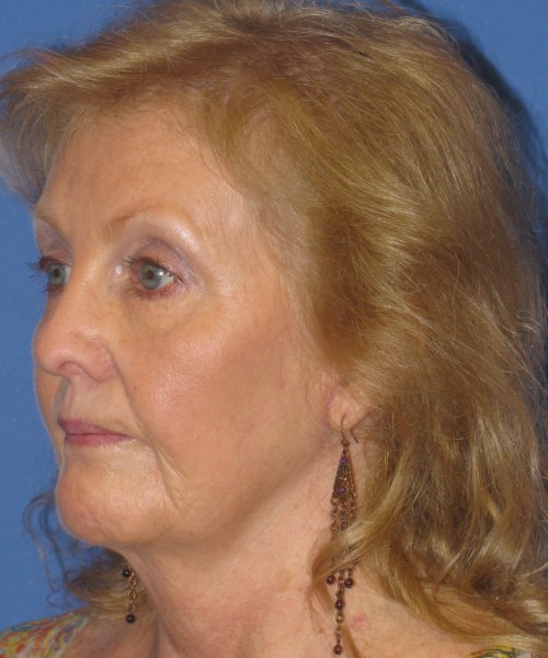 Facelift 1076 – Click HERE for more views after photo. Individual results may vary.