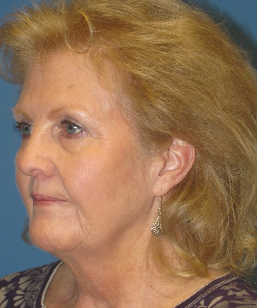 Facelift 1076 – Click HERE for more views before photo. Individual results may vary.