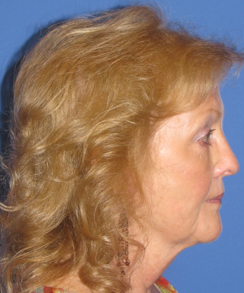Facelift 1076 – Click HERE for more views after photo. Individual results may vary.