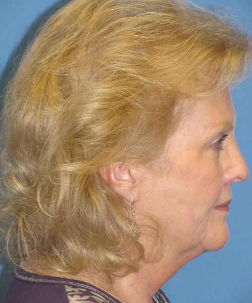 Facelift 1076 – Click HERE for more views before photo. Individual results may vary.