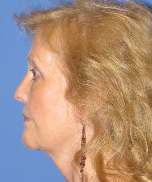Facelift 1076 – Click HERE for more views after photo. Individual results may vary.