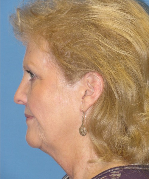 Facelift 1076 – Click HERE for more views before photo. Individual results may vary.