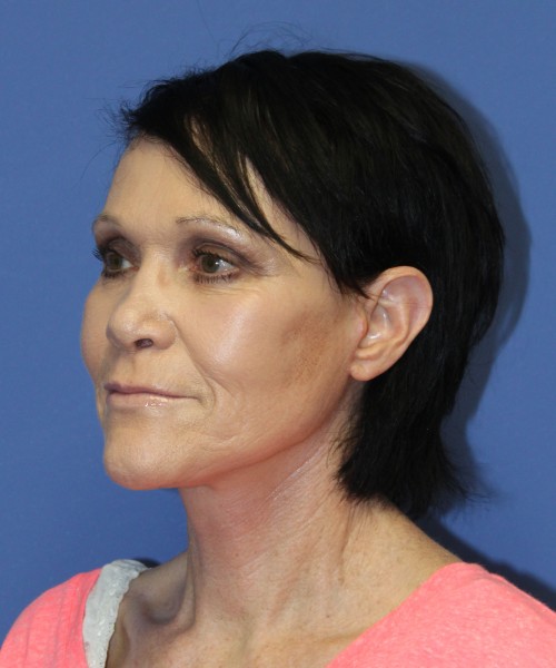 Facelift 1128 – Click HERE for more views after photo. Individual results may vary.
