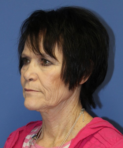 Facelift 1128 – Click HERE for more views before photo. Individual results may vary.