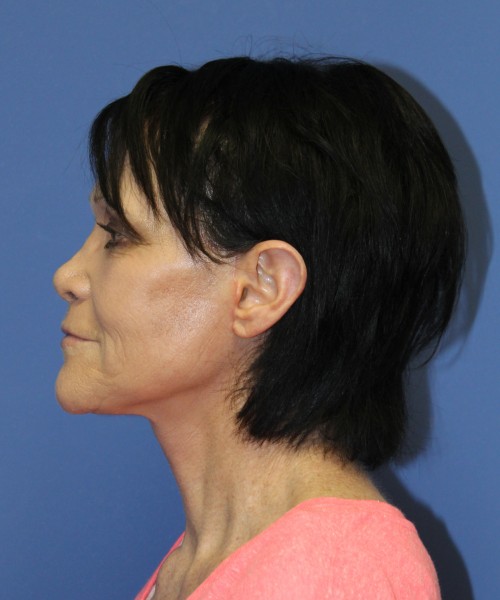 Facelift 1128 – Click HERE for more views after photo. Individual results may vary.