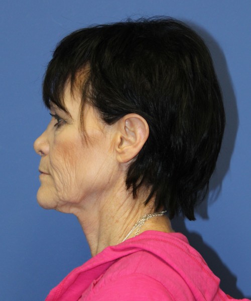 Facelift 1128 – Click HERE for more views before photo. Individual results may vary.