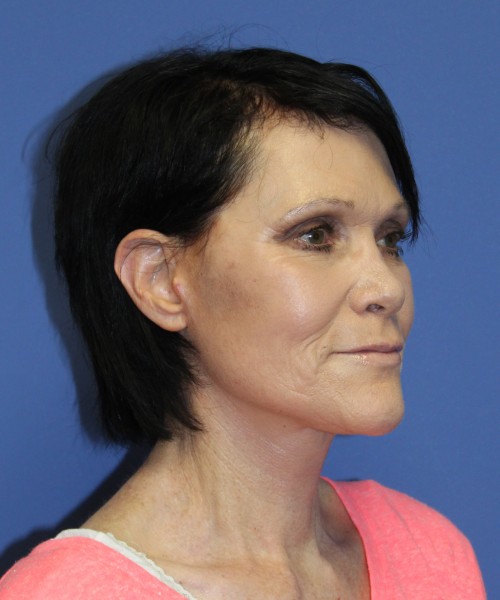 Facelift 1128 – Click HERE for more views after photo. Individual results may vary.