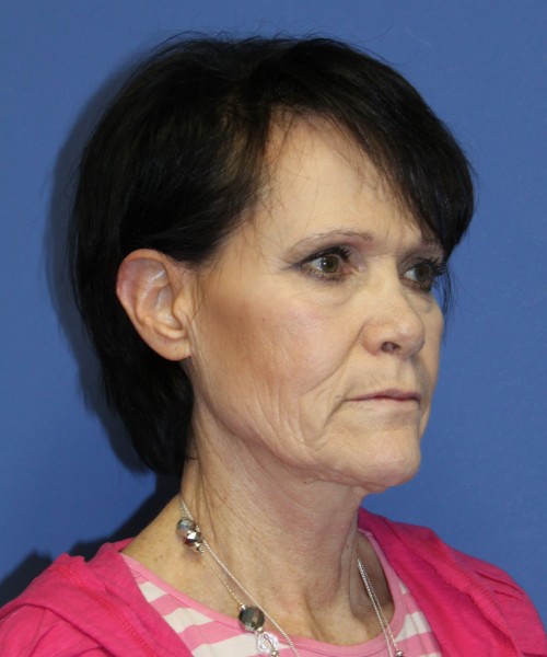 Facelift 1128 – Click HERE for more views before photo. Individual results may vary.