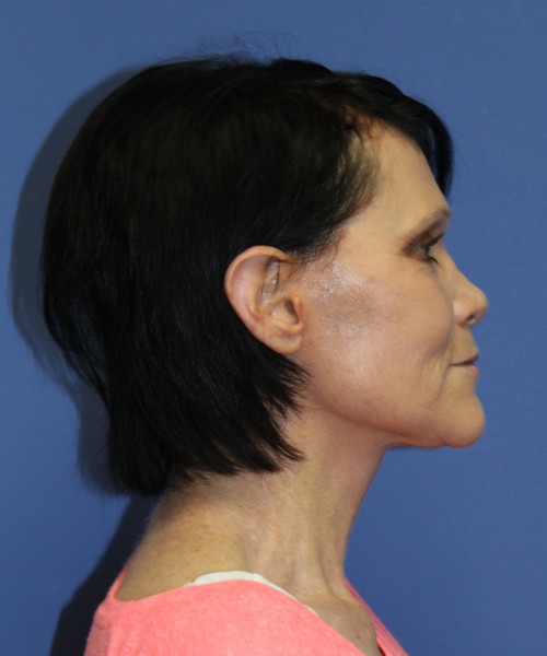 Facelift 1128 – Click HERE for more views after photo. Individual results may vary.