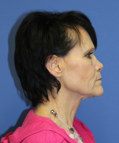 Facelift 1128 – Click HERE for more views before photo. Individual results may vary.