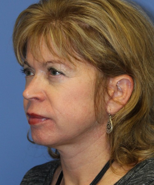 Facelift 1129 – Click HERE for more views after photo. Individual results may vary.