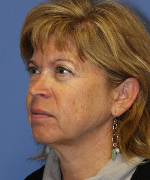 Facelift 1129 – Click HERE for more views before photo. Individual results may vary.