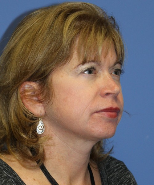 Facelift 1129 – Click HERE for more views after photo. Individual results may vary.