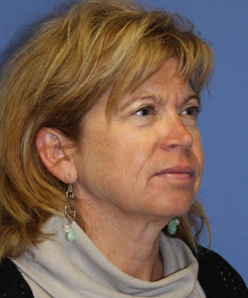 Facelift 1129 – Click HERE for more views before photo. Individual results may vary.