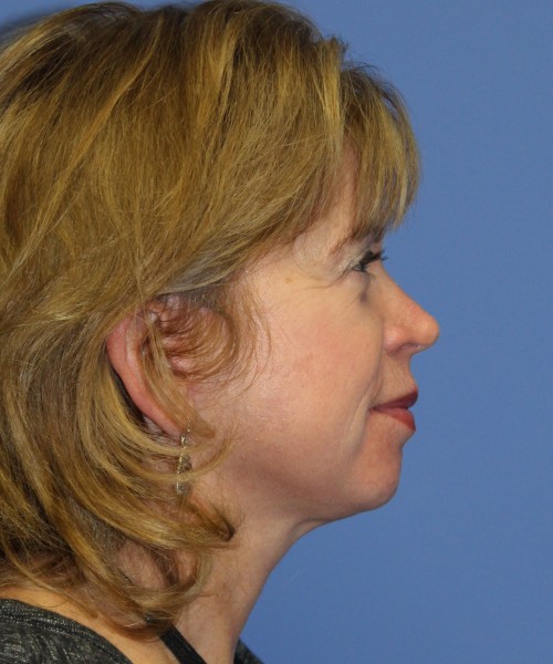 Facelift 1129 – Click HERE for more views after photo. Individual results may vary.