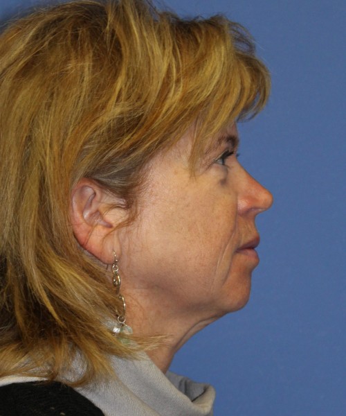 Facelift 1129 – Click HERE for more views before photo. Individual results may vary.