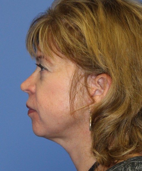 Facelift 1129 – Click HERE for more views after photo. Individual results may vary.