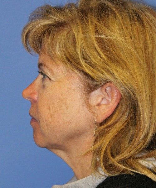 Facelift 1129 – Click HERE for more views before photo. Individual results may vary.