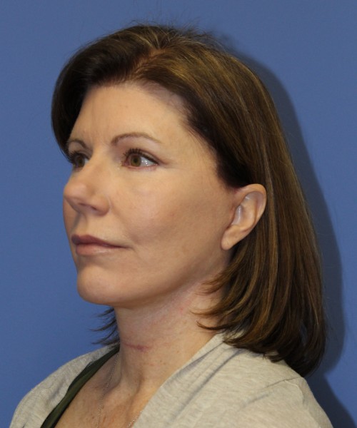 Facelift 1130 – Click HERE for more views after photo. Individual results may vary.