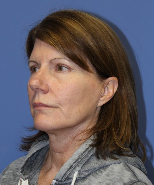 Facelift 1130 – Click HERE for more views before photo. Individual results may vary.
