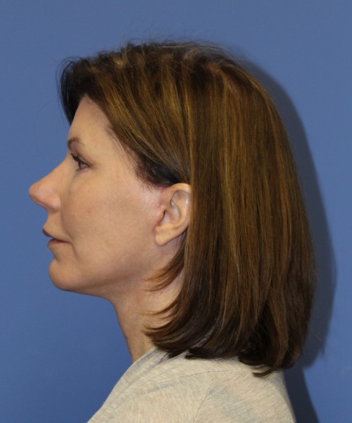 Facelift 1130 – Click HERE for more views after photo. Individual results may vary.