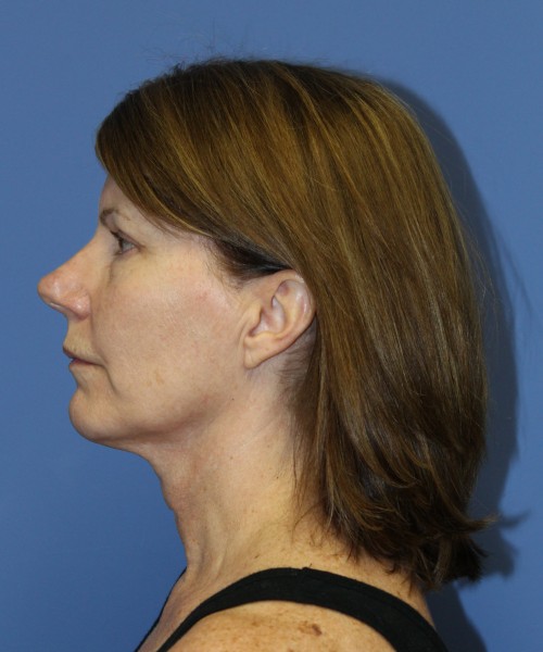 Facelift 1130 – Click HERE for more views before photo. Individual results may vary.