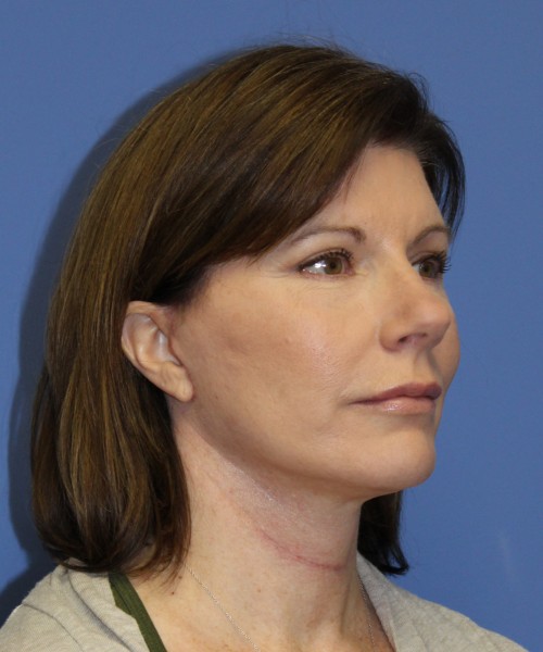 Facelift 1130 – Click HERE for more views after photo. Individual results may vary.