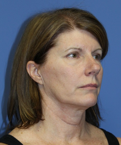 Facelift 1130 – Click HERE for more views before photo. Individual results may vary.