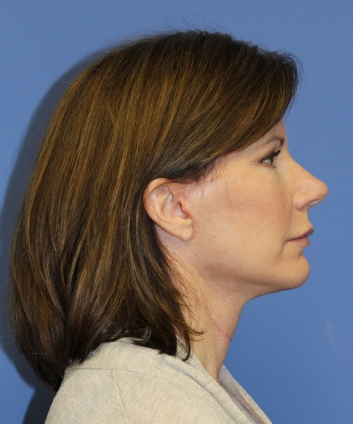 Facelift 1130 – Click HERE for more views after photo. Individual results may vary.