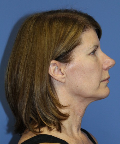 Facelift 1130 – Click HERE for more views before photo. Individual results may vary.