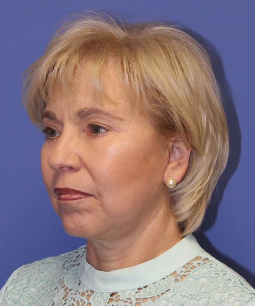 Facelift 1132 – Click HERE for more views after photo. Individual results may vary.