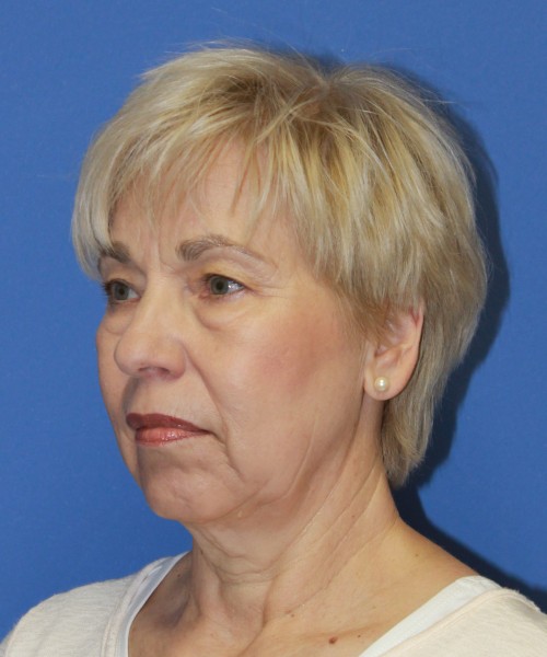 Facelift 1132 – Click HERE for more views before photo. Individual results may vary.