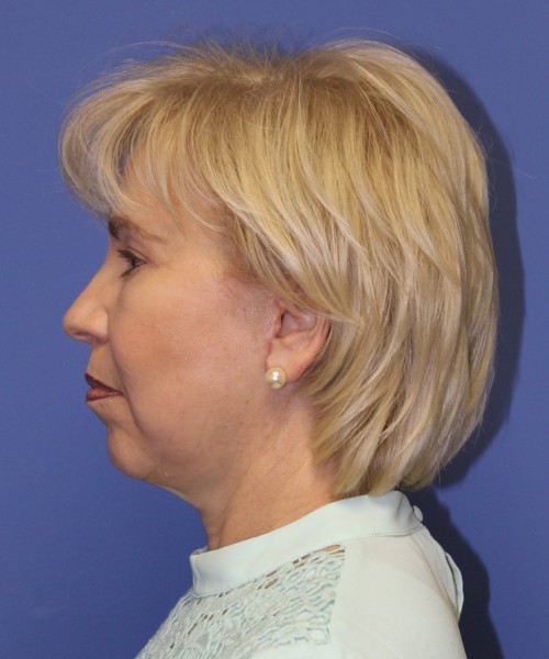 Facelift 1132 – Click HERE for more views after photo. Individual results may vary.