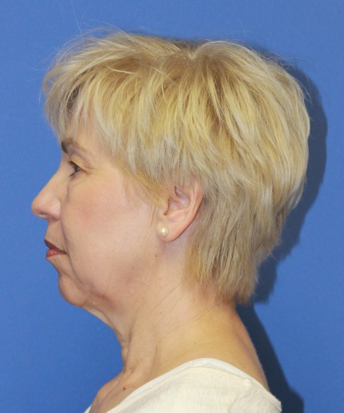 Facelift 1132 – Click HERE for more views before photo. Individual results may vary.