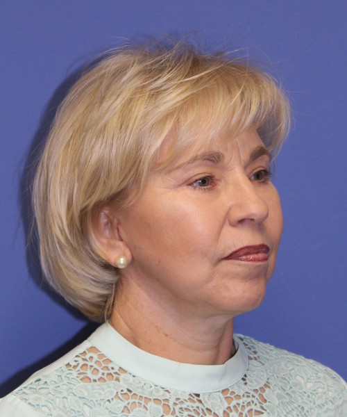 Facelift 1132 – Click HERE for more views after photo. Individual results may vary.