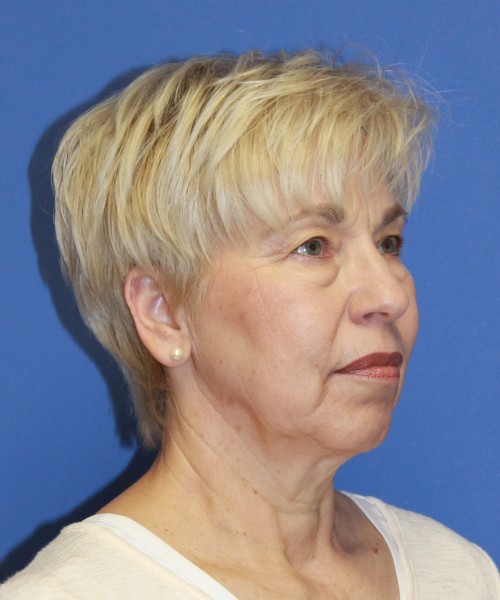 Facelift 1132 – Click HERE for more views before photo. Individual results may vary.