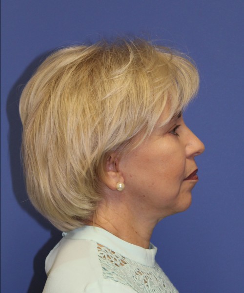 Facelift 1132 – Click HERE for more views after photo. Individual results may vary.