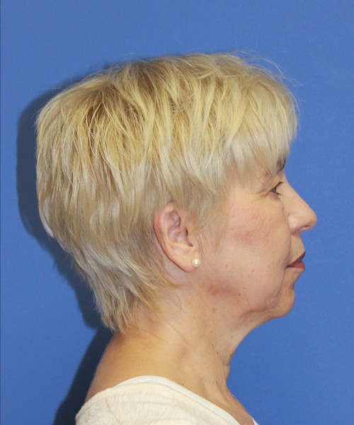 Facelift 1132 – Click HERE for more views before photo. Individual results may vary.