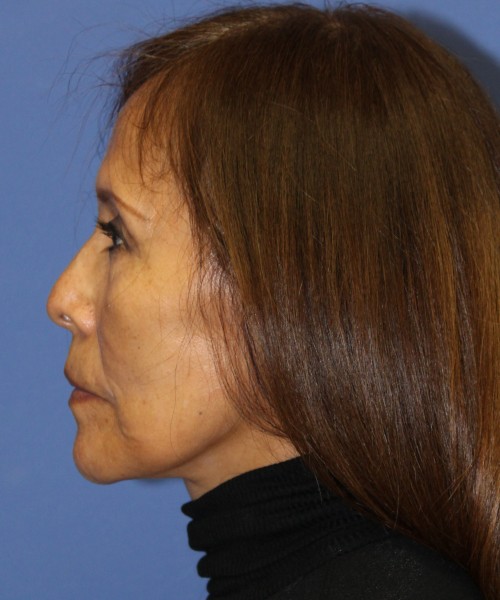 Facelift 1230 – Click HERE for more views after photo. Individual results may vary.