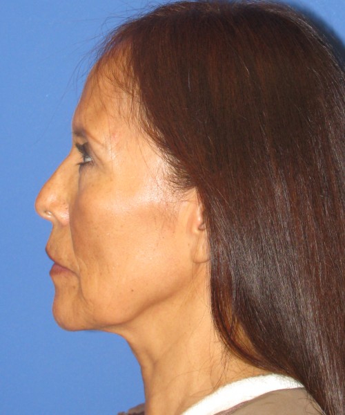 Facelift 1230 – Click HERE for more views before photo. Individual results may vary.
