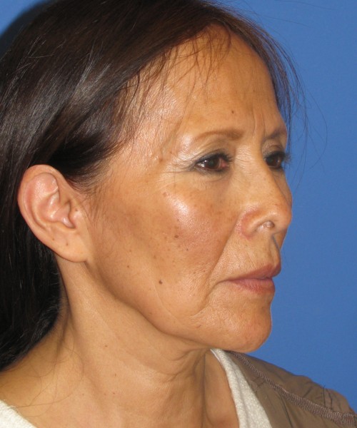 Facelift 1230 – Click HERE for more views before photo. Individual results may vary.