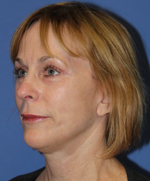 Facelift 1231 – Click HERE for more views after photo. Individual results may vary.